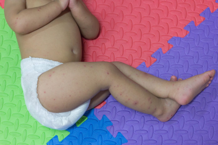 De plus en plus de cas de rougeole en Europe, ©123RF