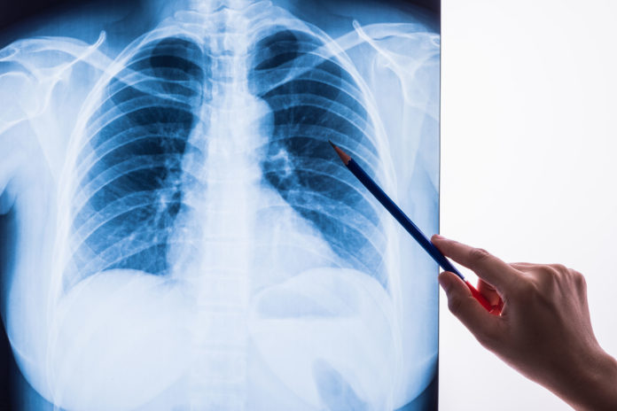 Bpco, maladies pulmonaires, covid-19 123RF©