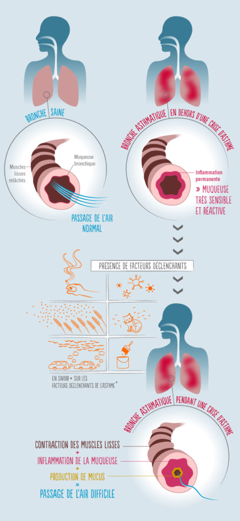 La journée mondiale de l'asthme, organisée cette année le 3 mai, vise à sensibiliser et informer le public sur cette maladie respiratoire de plus en plus répandue. Pus de 4 millions de Français sont asthmatiques. Et l'élargissement des connaissances communes permettra d'améliorer leur prise en charge. Du diagnostic aux traitements, jusqu’au suivi…