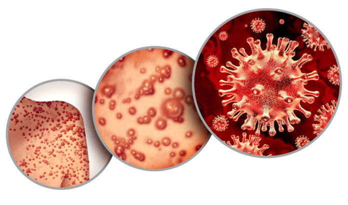 Virus de la variole du singe