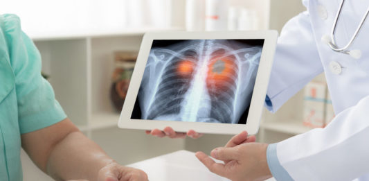 Un médecin informe sa patiente que le cancer du poumon